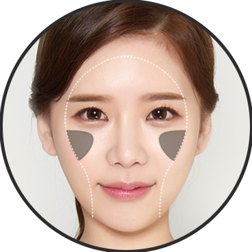 วอลลุ่ม — เติมไขมันโหนกแก้มด้านหน้า + ลดโหนกแก้มด้านข้าง
