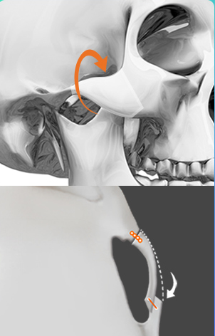 การหมุน — แผนภาพการหมุนกระดูกโหนกแก้ม (CT ด้านหน้า·ด้านข้าง)