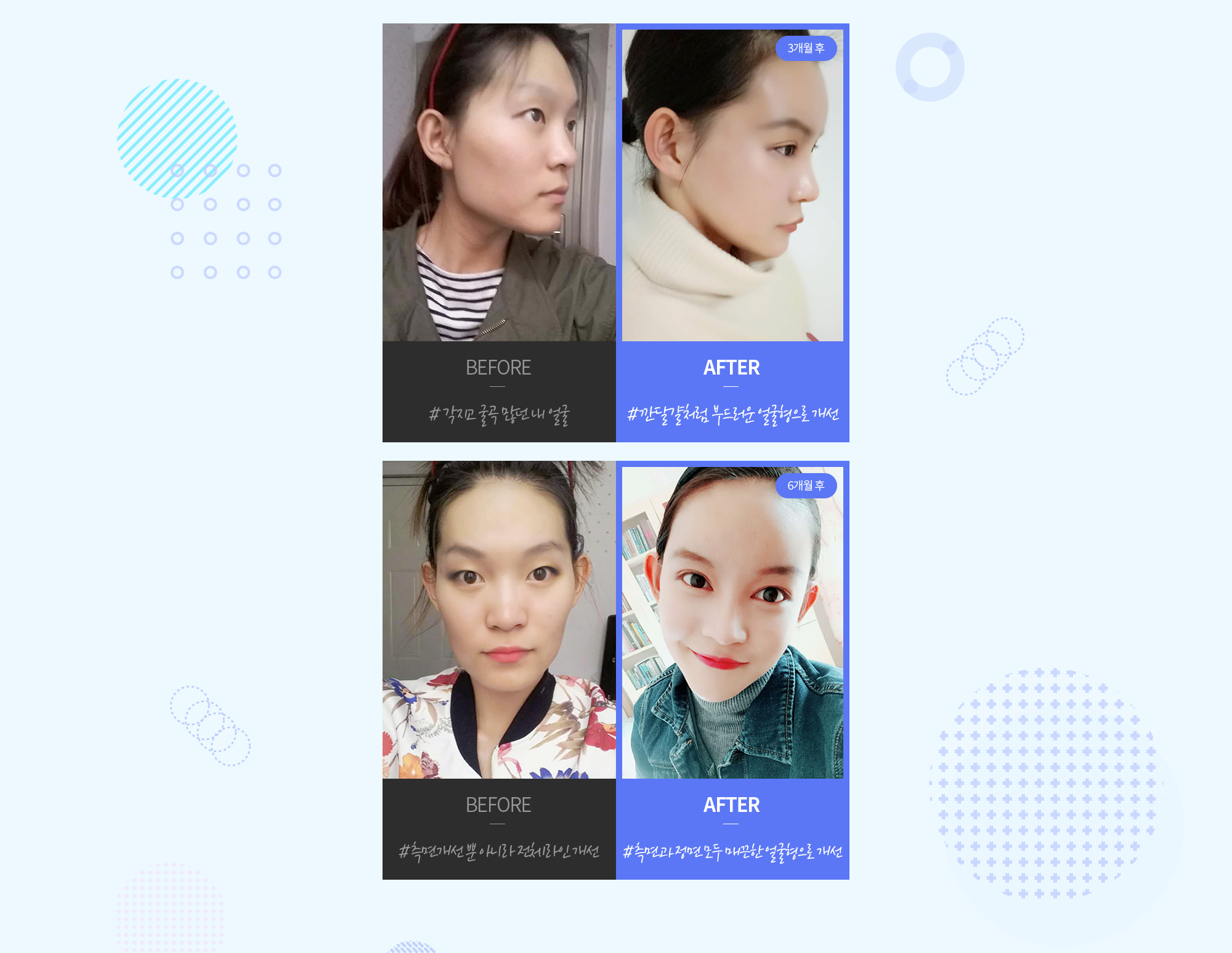 ศัลยกรรมลดโหนกแก้ม H-Mihak REAL ภาพก่อนและหลัง — CASE 1: ด้านหน้า·ด้านข้าง BEFORE/AFTER (#ใบหน้าของฉันที่เคยเหลี่ยมและมีมุมเว้ามาก → #ปรับเป็นรูปหน้าที่นุ่มนวลเหมือนไข่ปอกเปลือก, หลัง 6 เดือน). CASE 2: ด้านหน้า·ด้านข้าง BEFORE/AFTER (#ไม่เพียงปรับด้านข้าง แต่ปรับไลน์โดยรวม → #ปรับเป็นรูปหน้าที่เรียบเนียนทั้งด้านข้างและด้านหน้า, หลัง 6 เดือน).