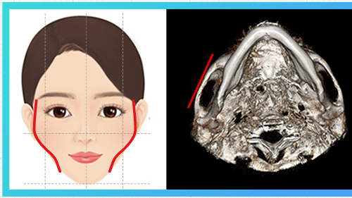 ประเภทโหนกแก้มด้านข้างนูน — แผนภาพโหนกแก้ม + CT