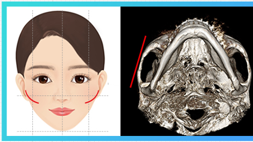 ประเภทโหนกแก้ม 45 องศานูน — แผนภาพโหนกแก้ม + CT