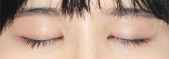 ภาพเปรียบเทียบก่อนและหลังทำ Ten Minute Natural Adhesion 2