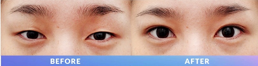 ภาพโพสต์ Instagram เปรียบเทียบดวงตาก่อนและหลัง Ten Minute Natural Adhesion