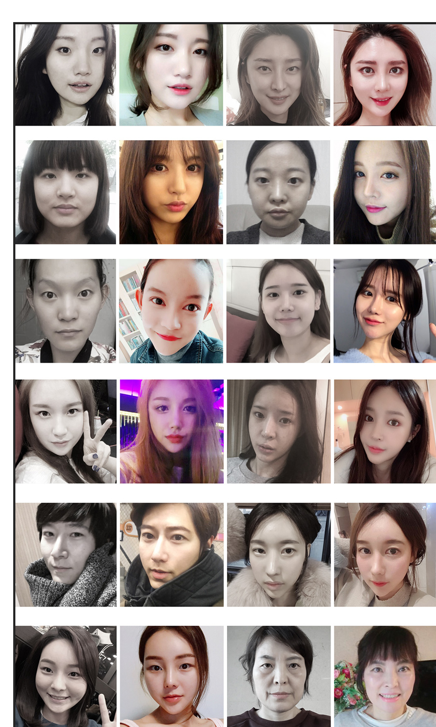 ศัลยกรรมแก้ไขการเปิดหัวตา/หางตา Hyundai BEFORE & AFTER