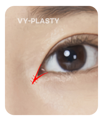 ภาพประกอบ V-Y flap