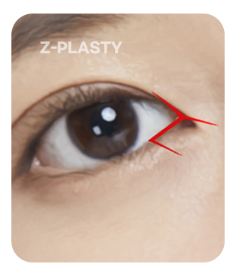 ภาพประกอบ Z-plasty flap