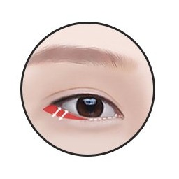 ขั้นตอนที่ 2 เปิดหางตาล่าง — เปิดเยื่อบุตาแล้วตรึงกับเยื่อหุ้มกระดูก