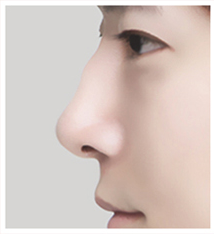 เคสด้านข้างของจมูกฮัมพ์ 1