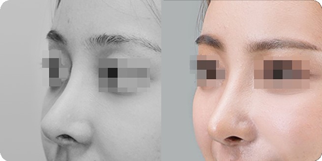 เปรียบเทียบด้านข้างก่อนและหลังศัลยกรรมจมูกแบบไม่ใช้วัสดุเสริมเทียม 1 (BEFORE / AFTER 3MONTH)