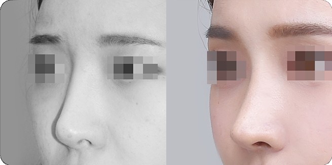 เปรียบเทียบด้านข้างก่อนและหลังศัลยกรรมจมูกแบบไม่ใช้วัสดุเสริมเทียม 2 (BEFORE / AFTER 3MONTH)