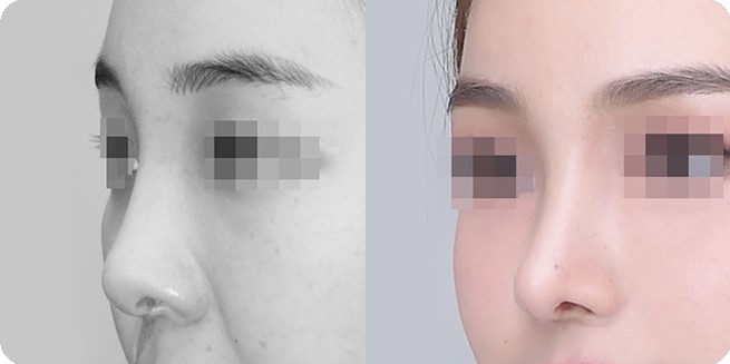 เปรียบเทียบด้านข้างก่อนและหลังศัลยกรรมจมูกแบบไม่ใช้วัสดุเสริมเทียม 3 (BEFORE / AFTER 3MONTH)